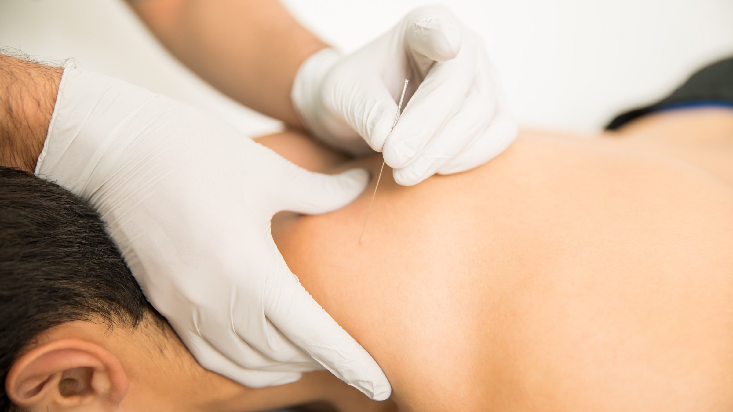 Dry needling administered in a clinic to relieve pain.