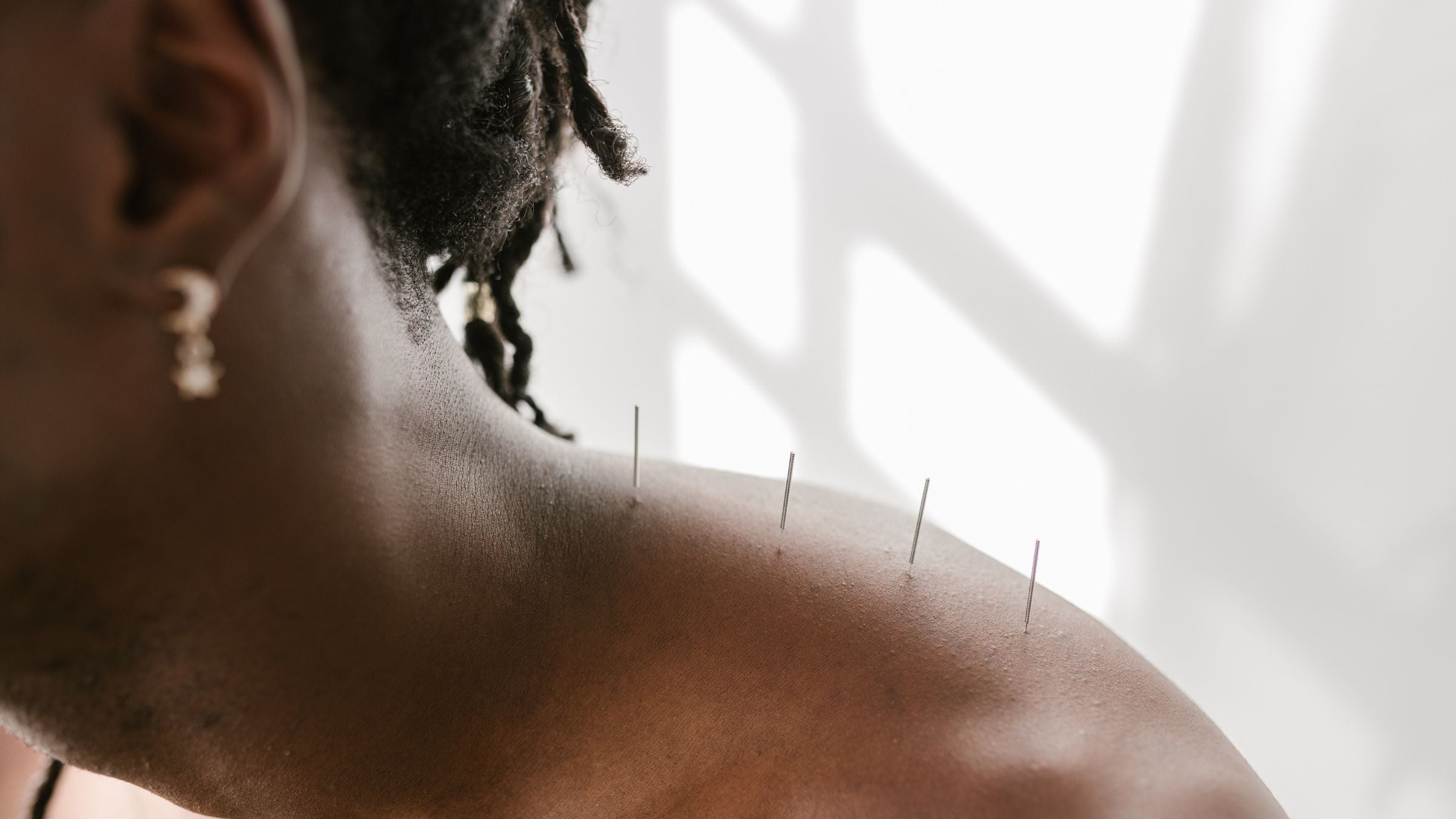 A female athlete has dry needling vs. acupuncture performed on her shoulder.