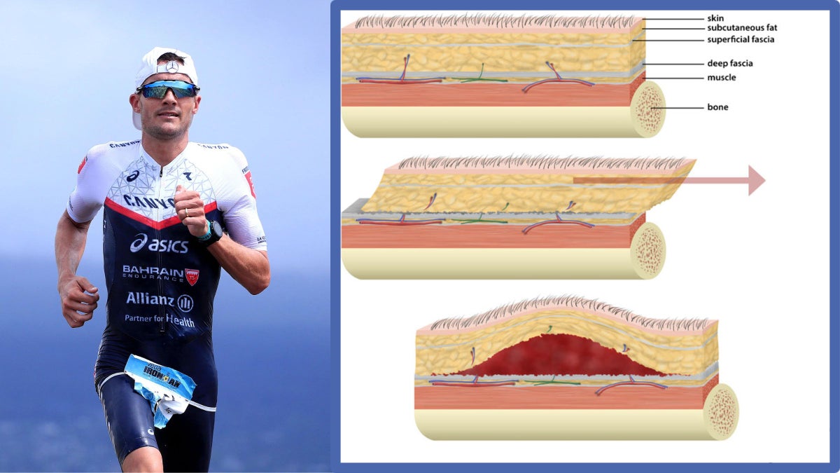 What Are MorelLavallée Lesions? Understanding Jan Frodeno's Injury